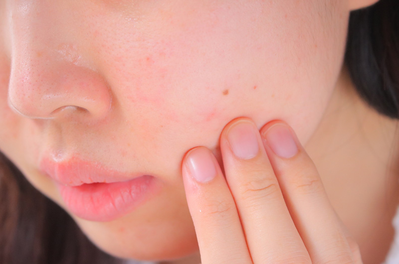 当院の肌荒れ・アトピー治療